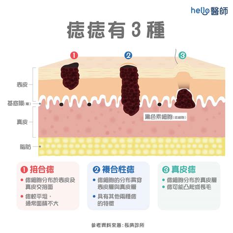 痣形成的原因